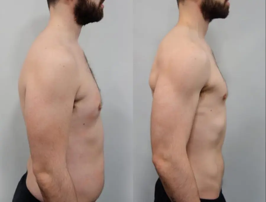Client body recomposition transformation before and after